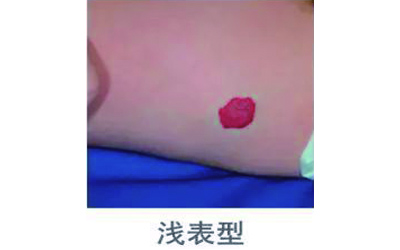 宝宝血管瘤破了应该怎么办,宝宝血管瘤破了怎么办