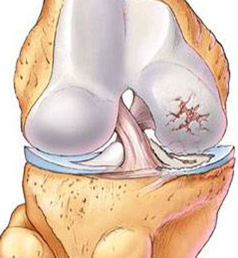 膝关节活动有响声应该看什么科室,膝关节活动有响声是怎么回事