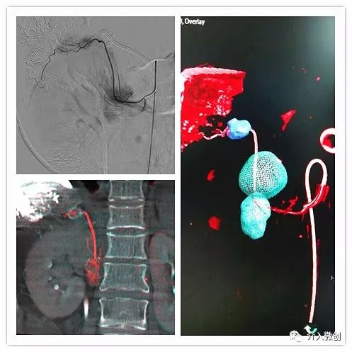 肝癌腹膜后淋巴结转移是怎么回事,肝癌腹腔淋巴结转移瘤意味着什么