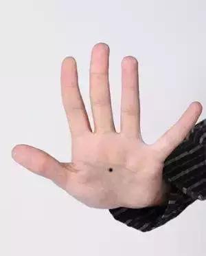 健康痣长在什么位置,黑痣长在什么地方容易癌变