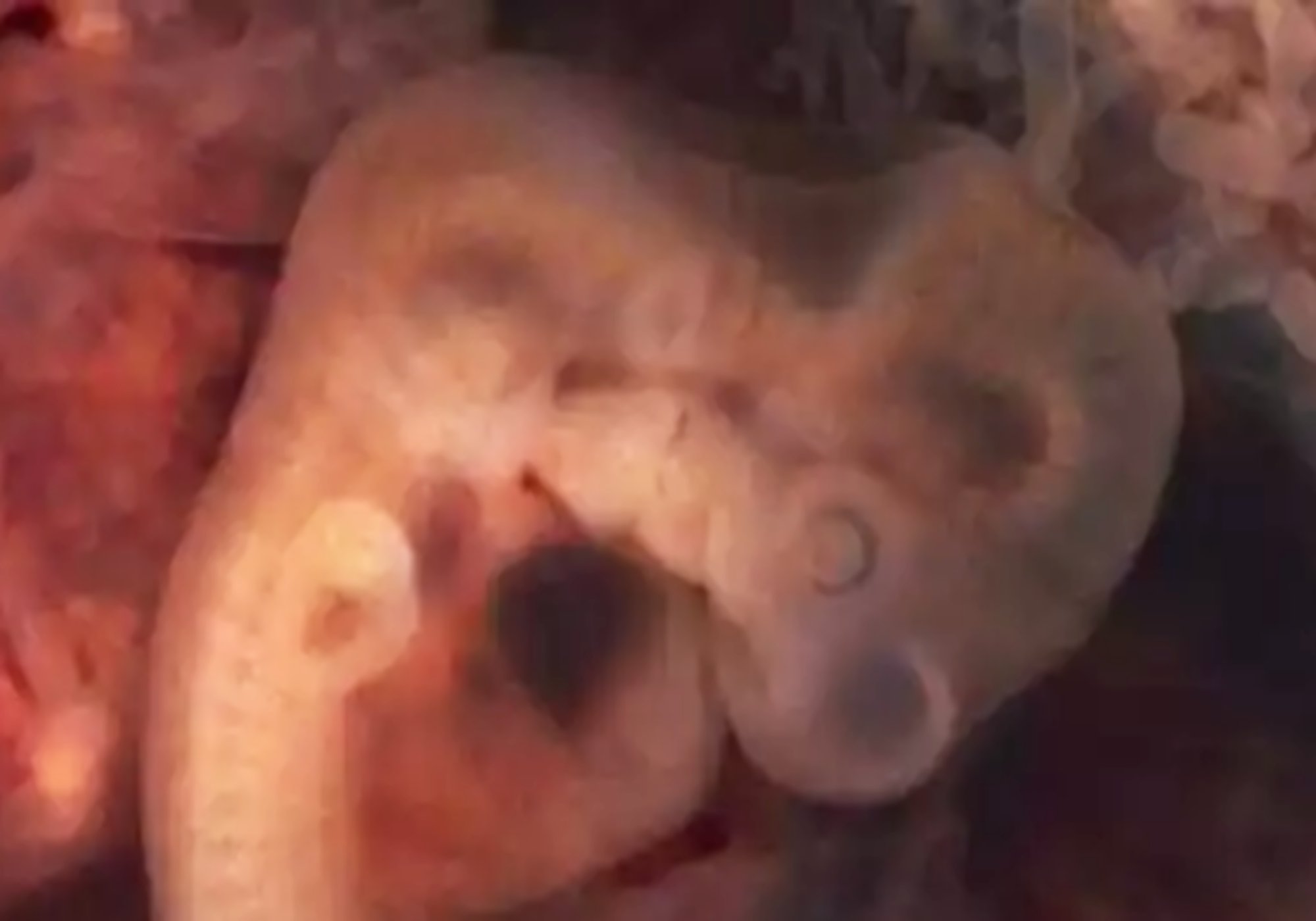 小孩一出生就有耳孔,宝宝有耳孔必须手术吗