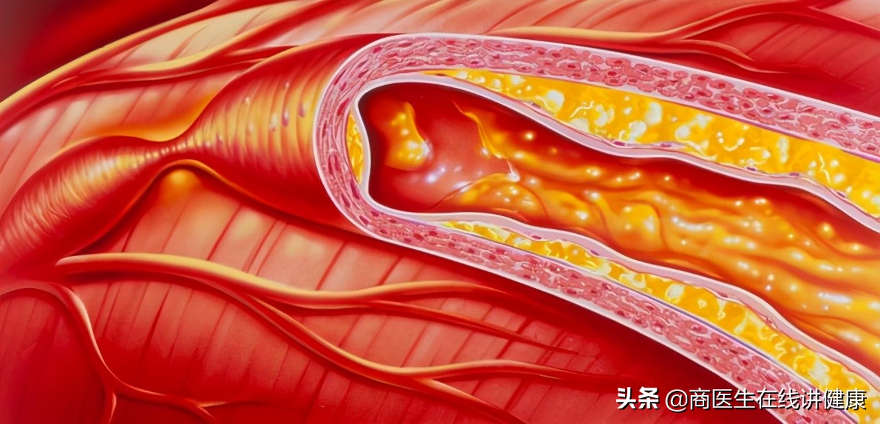叶酸能有效预防高血压吗,叶酸对预防脑梗有作用吗