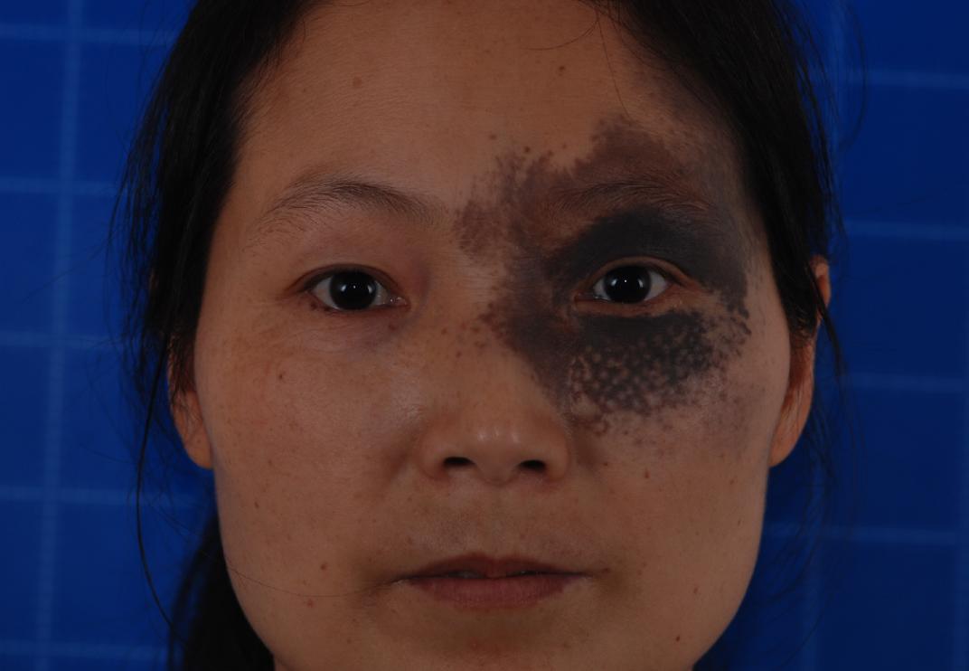 激光祛太田痣视频,疤痕太田痣皮秒激光祛斑恢复过程