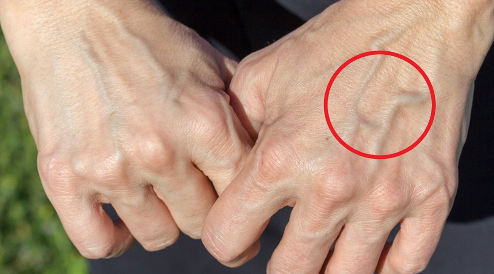 青筋暴起的青筋指的是什么,青筋暴起和没有青筋哪个健康