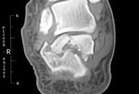 医学科普疑似骨折的正确处理方法,跟骨骨折彻底恢复的概率