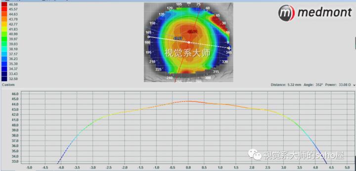 ok镜一周不戴近视更厉害吗,戴了ok镜真的可以恢复视力吗