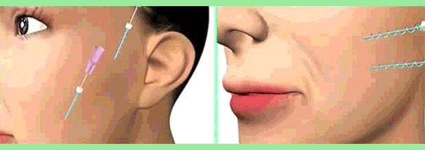 线雕隆鼻真相大揭秘,关于线雕十大热门问题解答