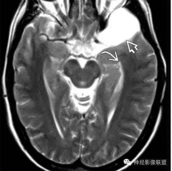 各种囊肿的症状,颅内囊肿18-19mm严重吗