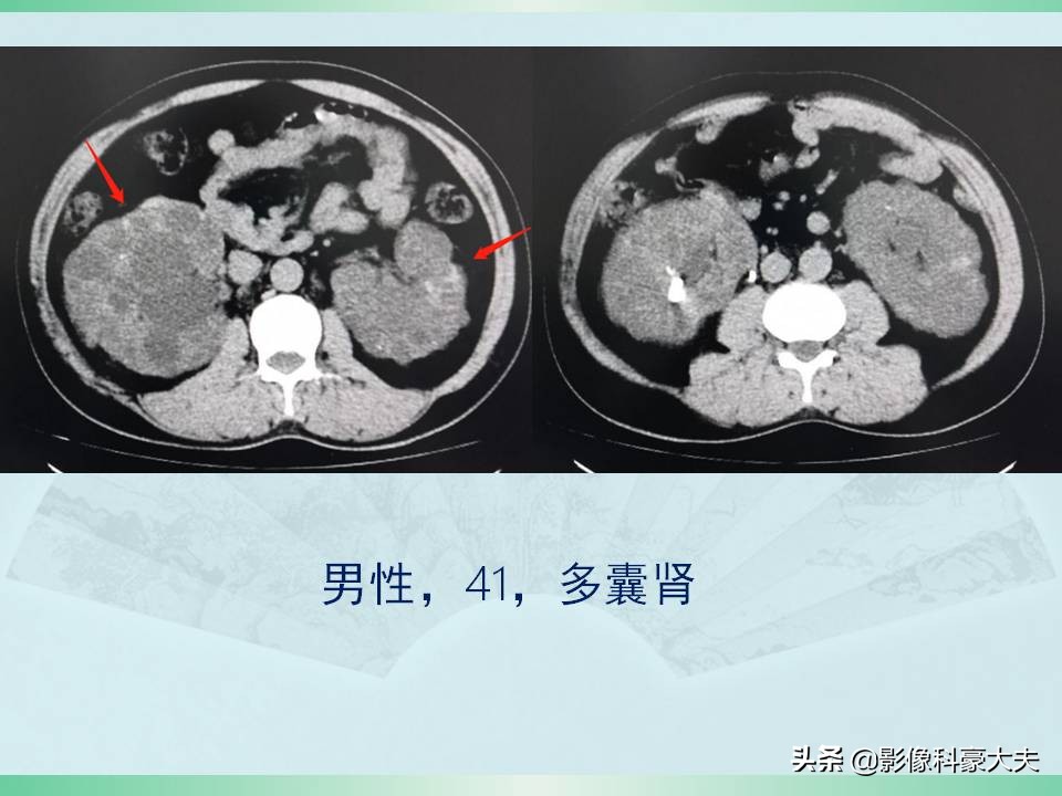 得了尿毒症又得了癌症怎么办,尿毒症为什么发病大多是年轻人呢