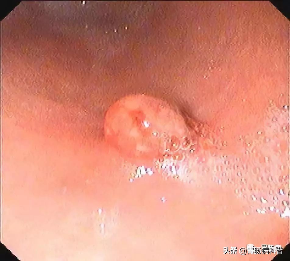 长了胃息肉怎么办,长了胃息肉怎么办才好