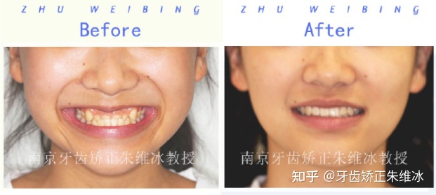 南京透明式牙齿矫正器地包天,18岁功能性地包天能改善面型吗