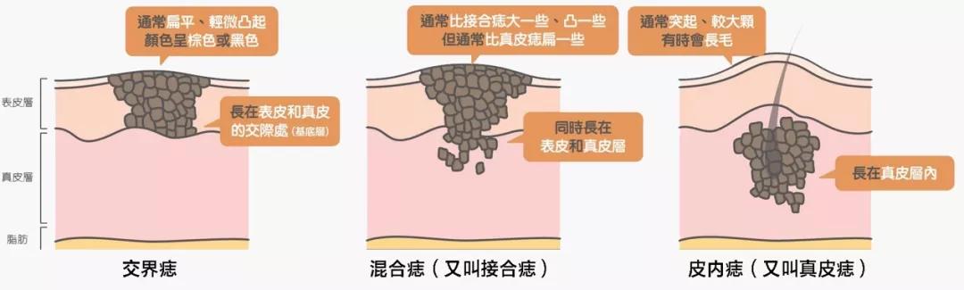 长在什么部位的痣最危险,长在哪些部位的痣需要特别注意