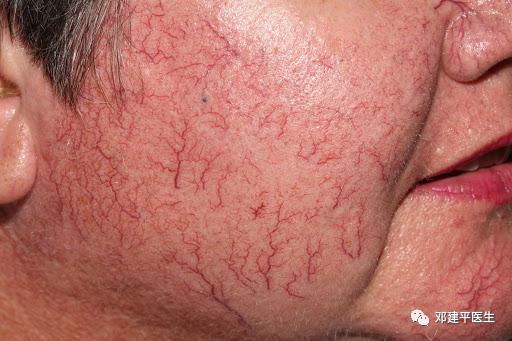 什么是毛细血管扩张,什么是毛细血管