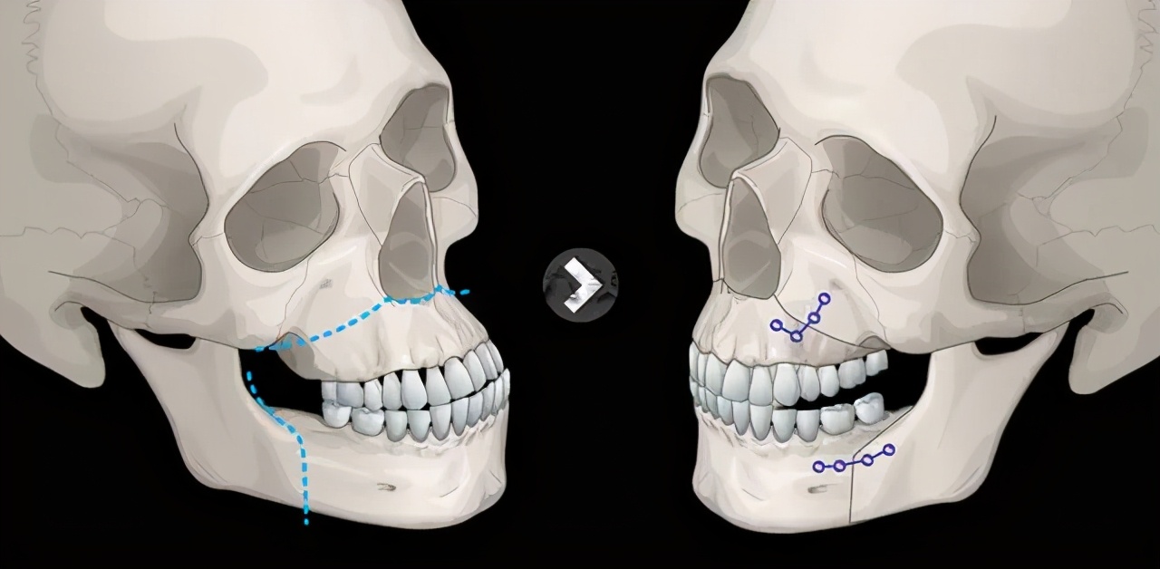 错颌畸形导致的脸歪矫正,矫正偏颌是什么原因导致的