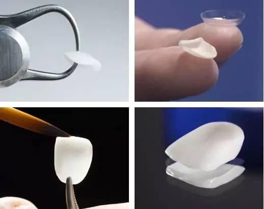 瓷贴面微笑的力量,局部瓷贴面