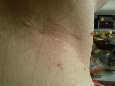 脖子上长米粒小肉疙瘩是怎么回事,脖子上长的小米粒肉疙瘩是什么