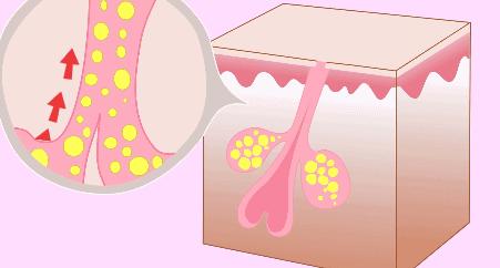 怎样改善油性皮肤问题,怎样改善油性皮肤长痘