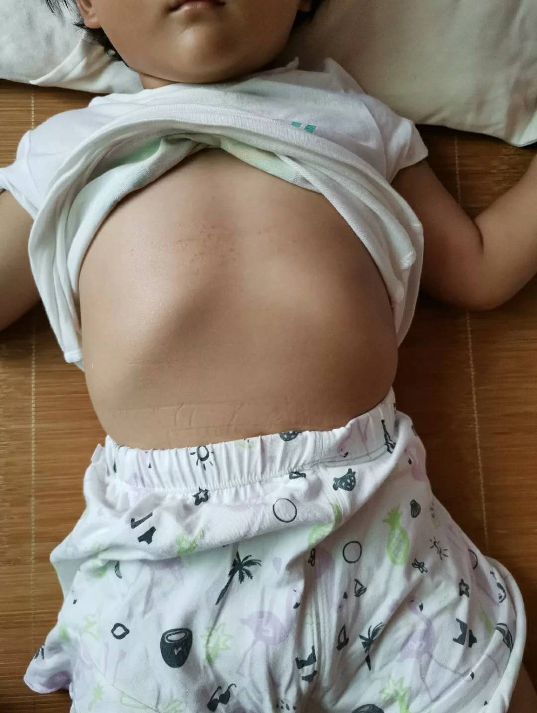 宝宝肋骨外翻是什么原因不缺钙,宝宝缺钙引起的肋骨外翻怎么办