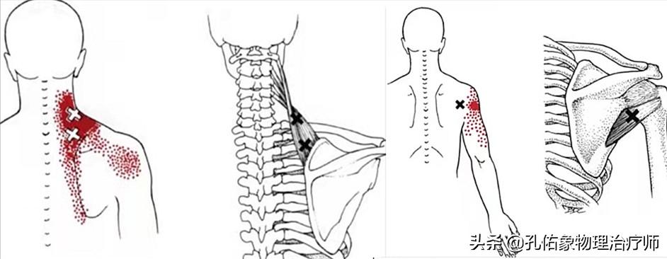 肩周炎肩膀疼痛用什么药,肩膀疼是肩周炎吗还是其他原因