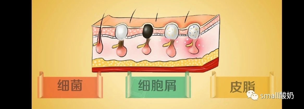 去黑头你真的用对了吗,真的好用的去黑头方法