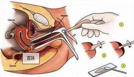 宫颈癌筛查正常还需要活检吗,做宫颈癌活检筛查有什么异样
