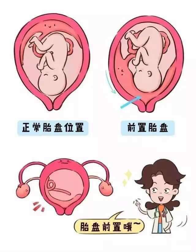 前置胎盘孕晚期如何避免出血,凶险性前置胎盘一般多少周会出血