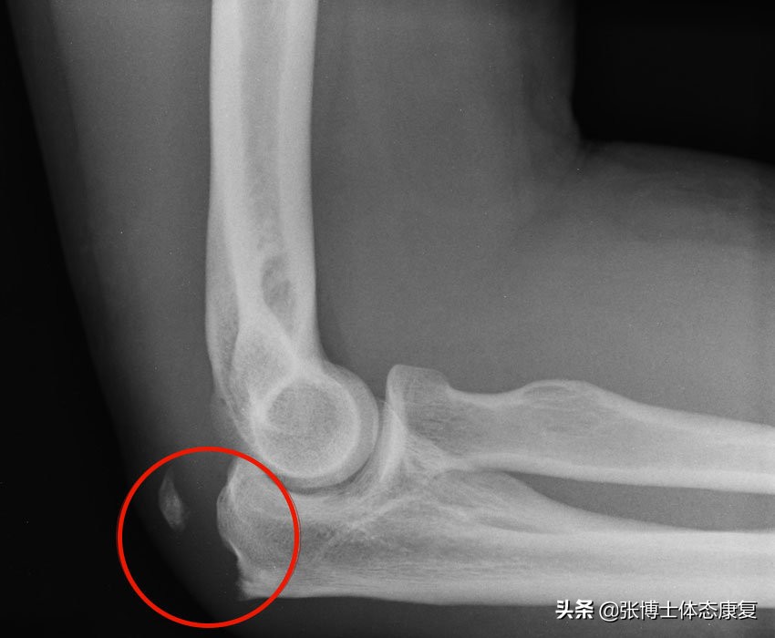 肘关节康复锻炼过度会造成什么,运动过量肘关节损伤如何恢复