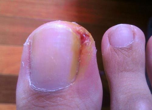 啃指甲拔倒刺可能会引起甲沟炎,啃手指啃出甲沟炎