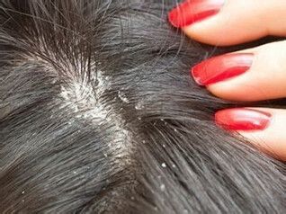 为什么鼻翼两侧发红还长痘,为什么会鼻翼两边泛红发痒