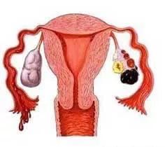 巧克力囊肿10cm做了穿刺备孕,怀孕发现有卵巢巧克力囊肿怎么办