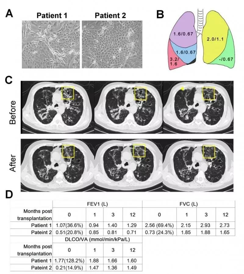 造血干细胞重获新生,神奇的干细胞让他们重获新生