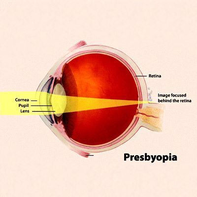 中年人需预防的疾病,中老年人预防眼睛疾病的最佳方法