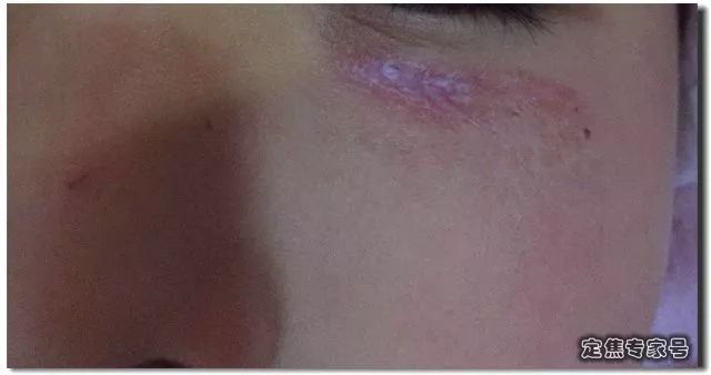 小孩脸上摔了口子能缝针吗,小孩脸摔破皮结痂后可以抹芦荟吗