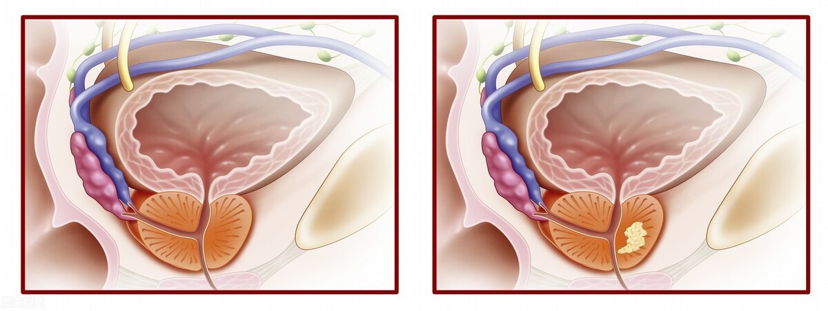 前列腺增生伴钙化能喝啤酒吗,得了前列腺可喝咖啡吗