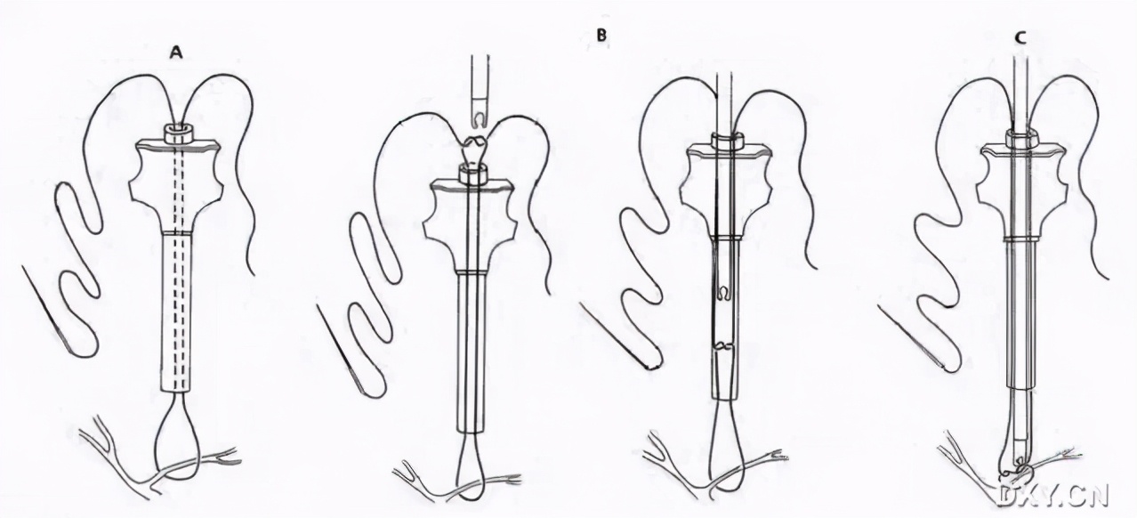 实用大全：腹腔镜下缝合与打结