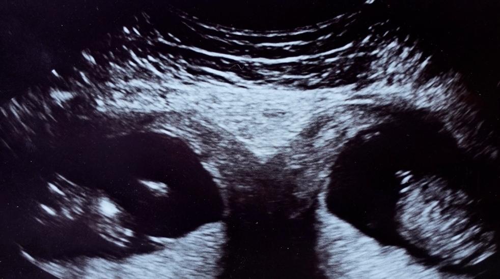 英国女子拥有两子宫，检查发现孕有双胞胎，概率仅为五千万分之一