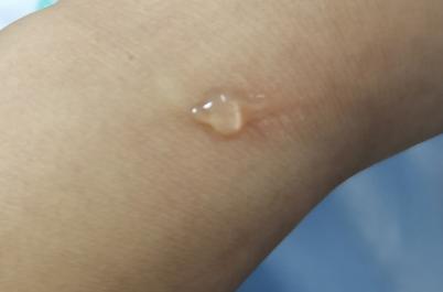 夏季蚊虫咬留疤怎么办,夏天蚊虫叮咬的疤会留白印吗