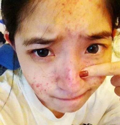 脸上的痘痘和粉刺的区别,女性常见的几种类型痘痘