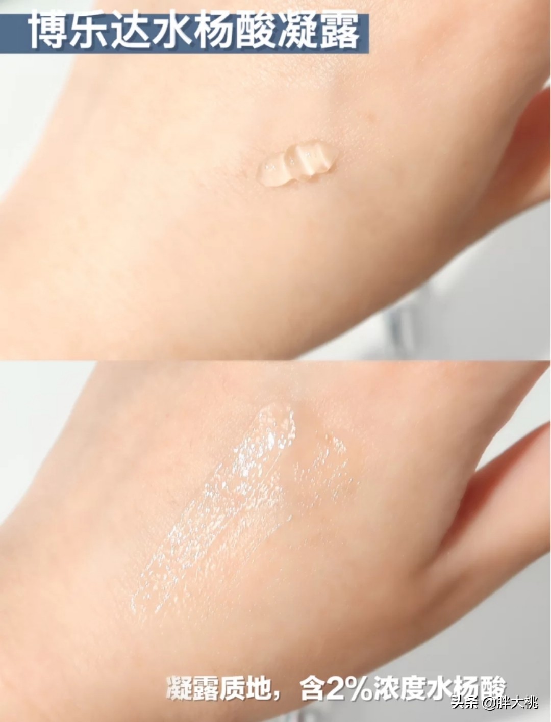 皮肤长黑头闭口刷酸真的可以吗,黑头刷酸有用吗能收缩毛孔吗