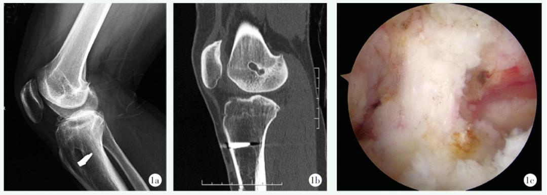 前交叉韧带重建不稳表现,膝盖前交叉韧带重建多久能恢复