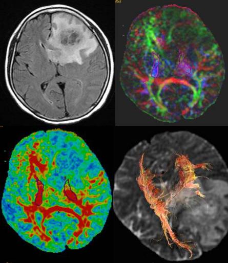 磁共振dti融合成像,磁共振dti成像作用