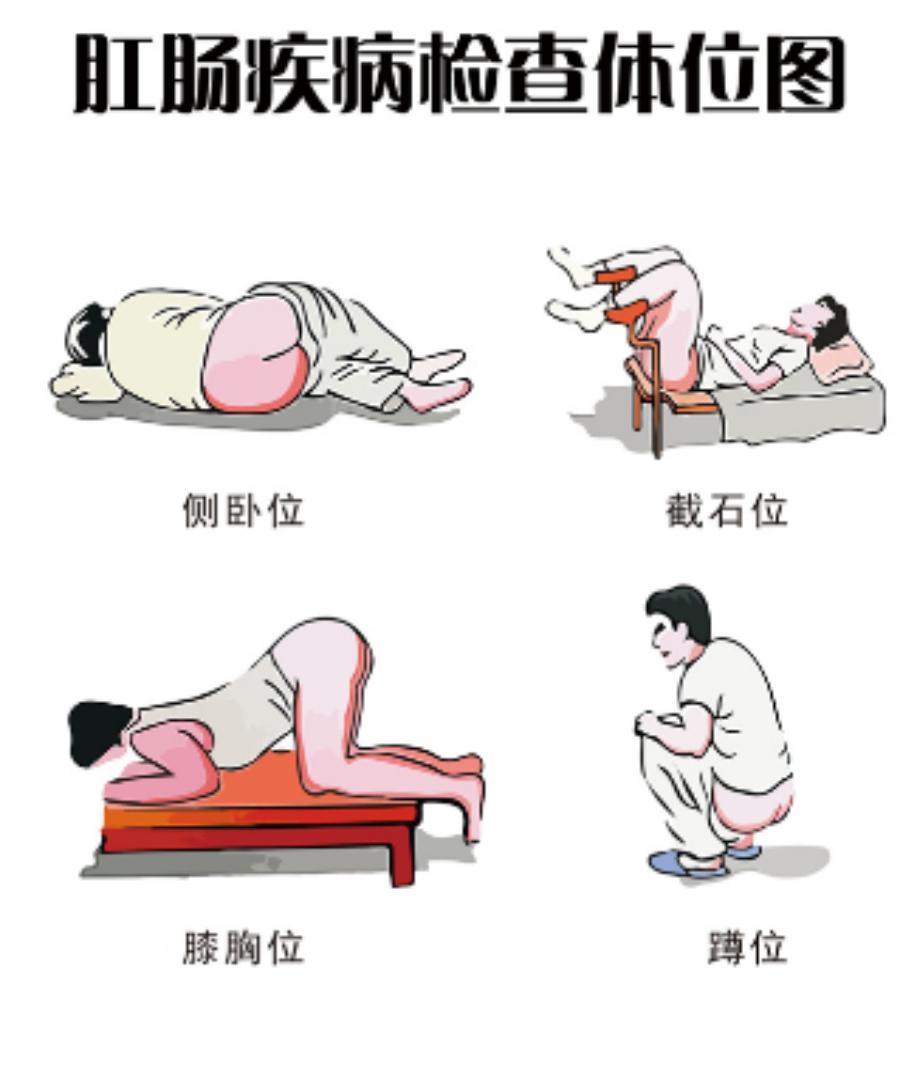 什么是肛门的局部检查法?