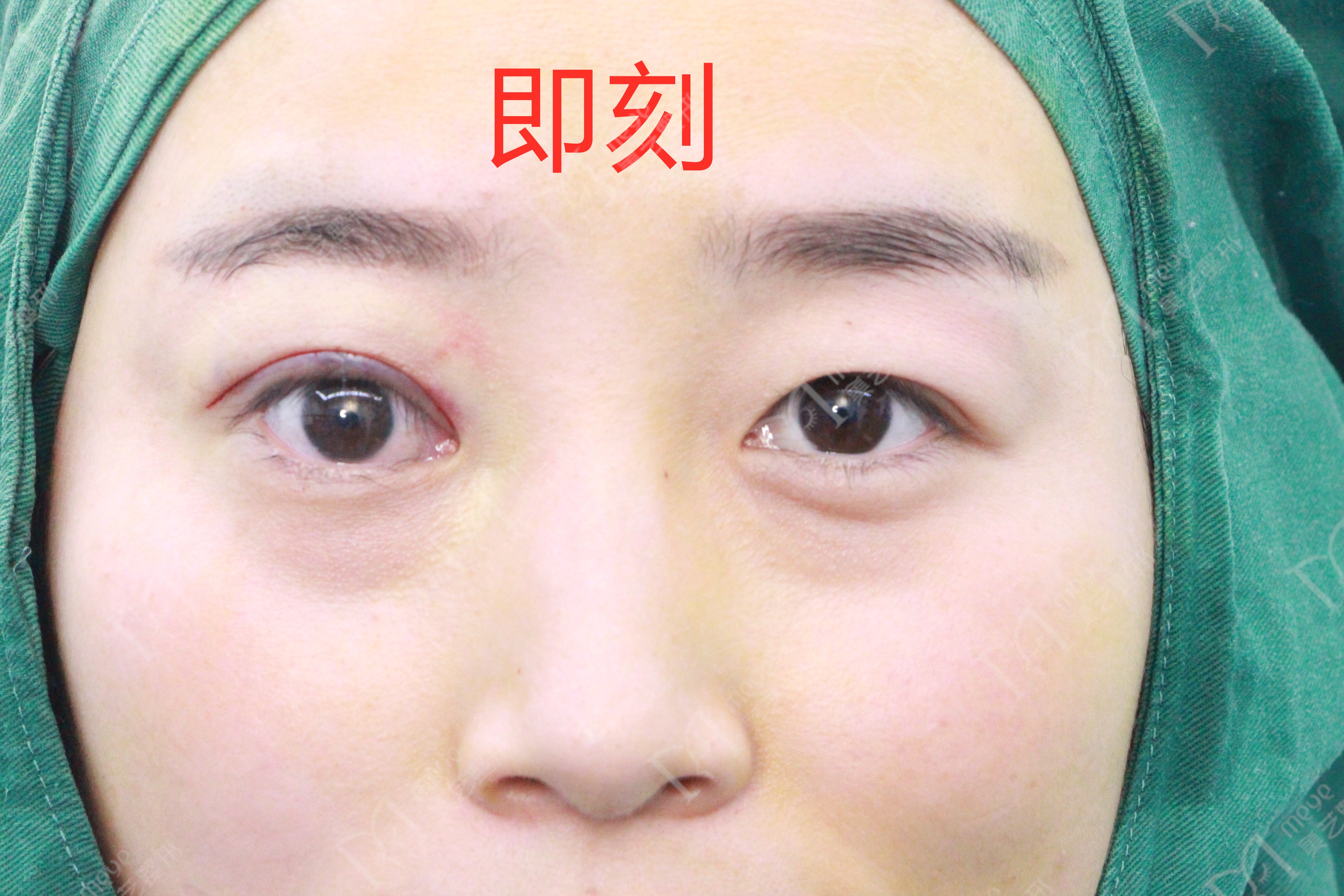 女子双眼皮术后大小眼,大小眼做了双眼皮感觉眼角不对称