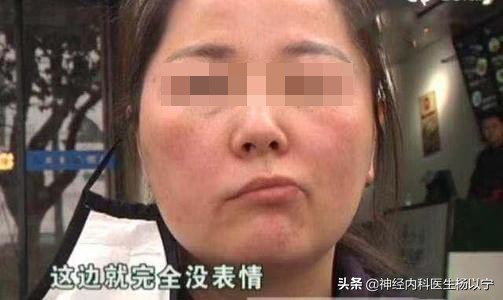 60岁面瘫老人嘴歪合不上嘴,老年人面瘫一边斜眼歪嘴