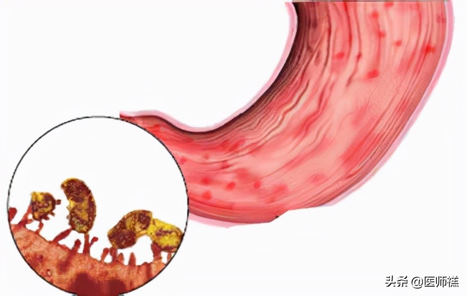 胃炎久治不愈查肿瘤标志物正常,胃炎一直拖着不治