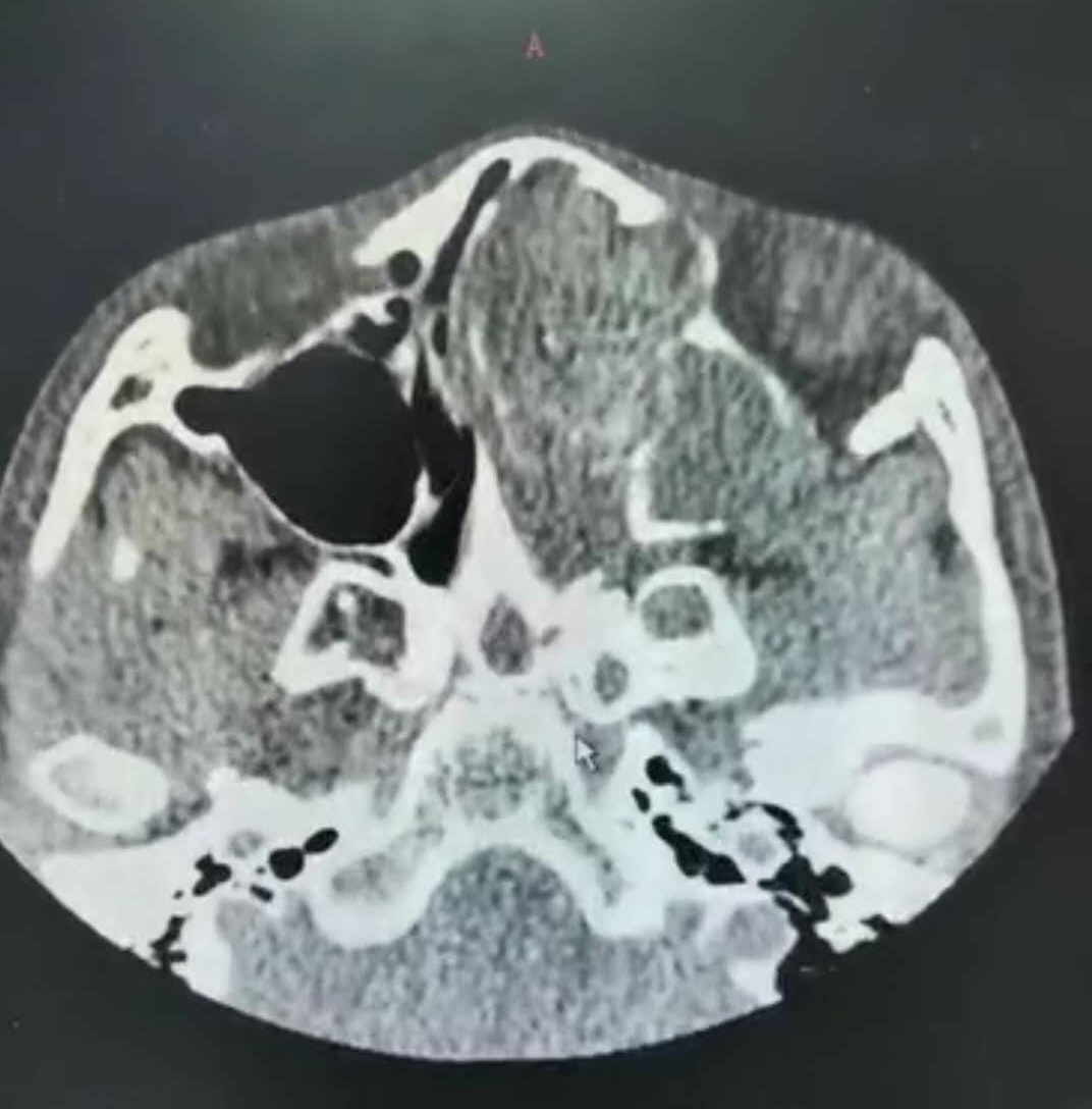 过敏性鼻炎导致脸过敏,孩子脸歪