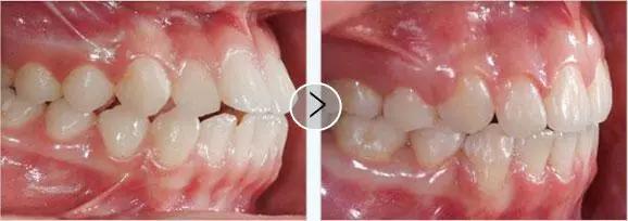 牙齿矫正拔牙后会反弹成原样么,牙齿矫正后反弹可以重新矫正吗