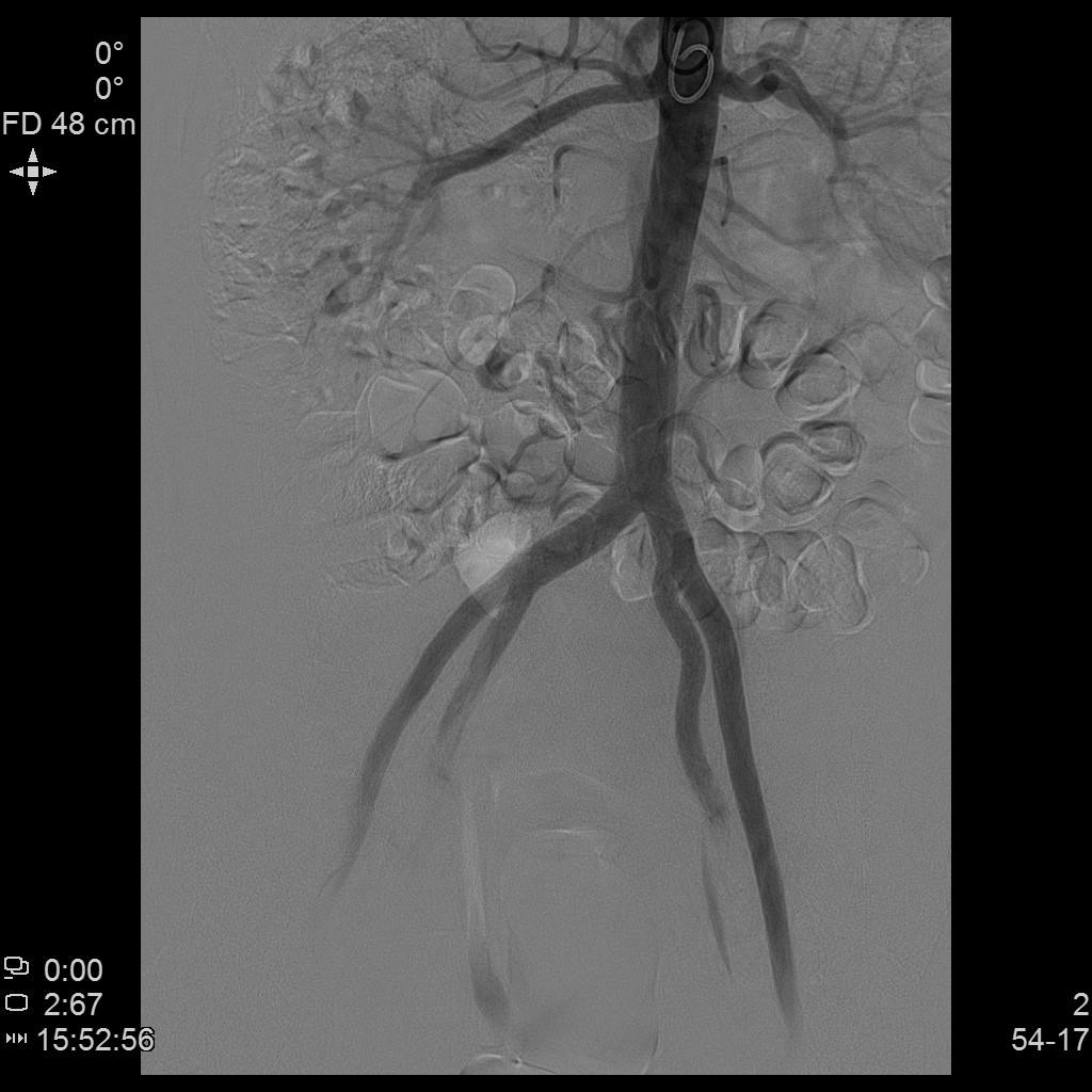 从手腕处做子宫动脉栓塞手术,子宫肌瘤做动脉穿刺有危险吗