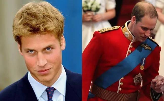 为什么英国人头越来越秃,英国谢顶