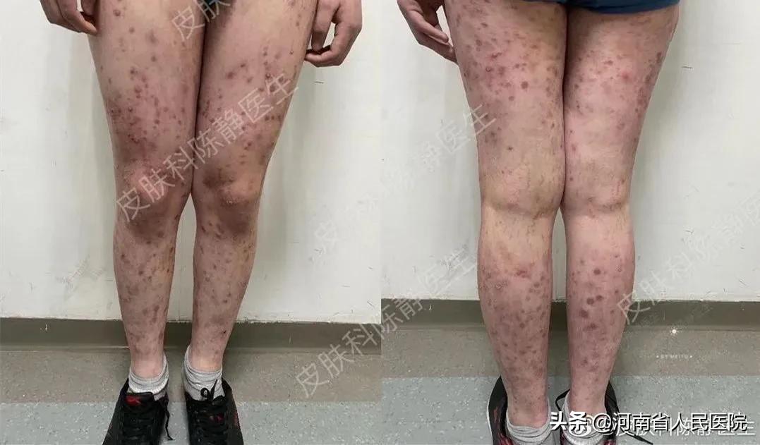 被痒吞噬的人们，是时候揭开这“湿疹”的真面目了